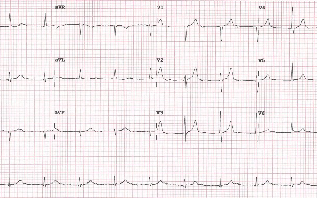 ECG Of The Month – June 2020