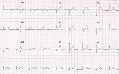 ECG Of The Month – June 2020