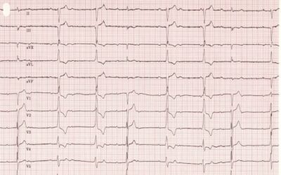 Dr Dave Richley’s ECG of the Month – July 2020