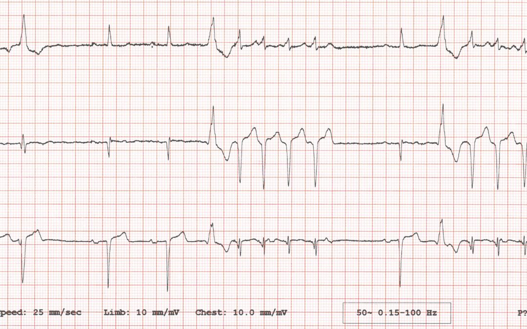 Dr Dave Richley’s ECG of the Month – October  2020