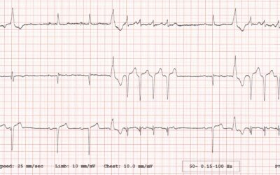 Dr Dave Richley’s ECG of the Month – October  2020