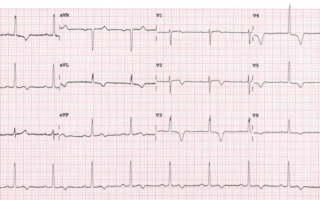 Dr Dave Richley’s ECG of the Month – November  2020
