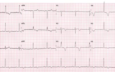 Dr Dave Richley’s ECG of the Month – November  2020