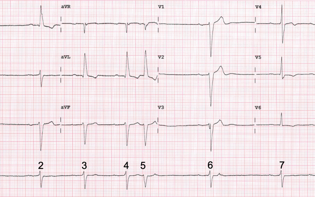 Dr Dave Richley’s ECG of the Month – December 2020