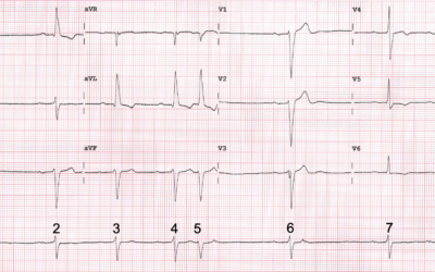 Dr Dave Richley’s ECG of the Month – December 2020