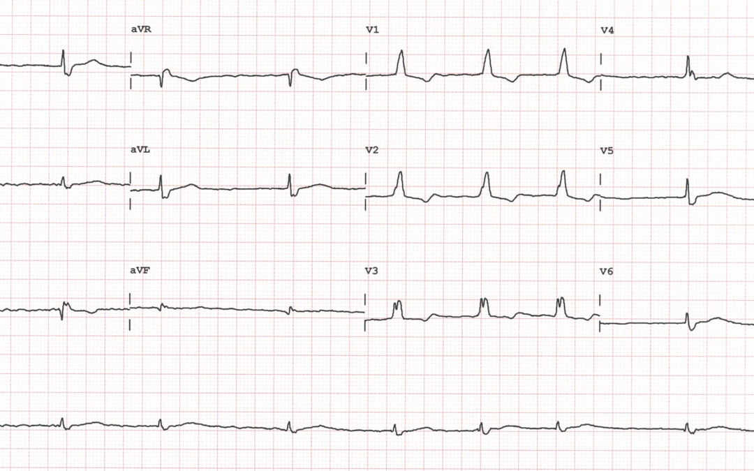 Dr Dave Richley ECG of the Month – April 2021