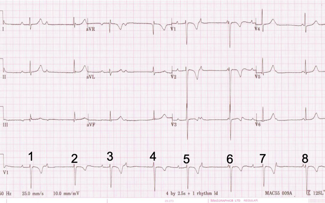 Dr Dave Richley ECG of the Month – May 2021