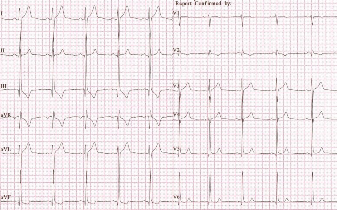 Dr Dave Richley ECG of the Month – June 2021