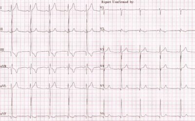 Dr Dave Richley ECG of the Month – June 2021