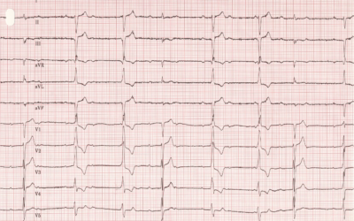Dr Dave Richley ECG of the Month – July 2021