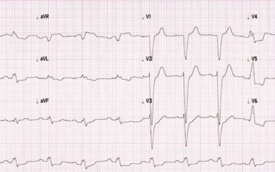 Dr Dave Richley ECG of the Month – August 2021