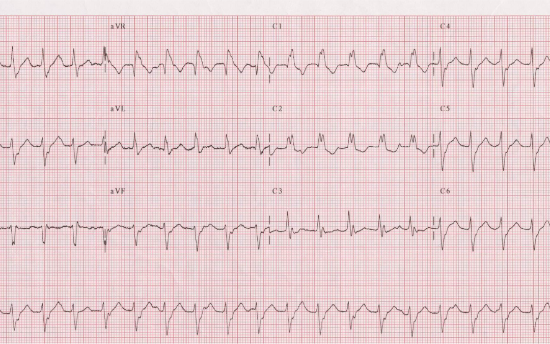 Dr Dave Richley ECG of the Month – October 2021