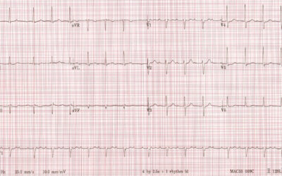 Dr Dave Richley ECG of the Month – December 2021