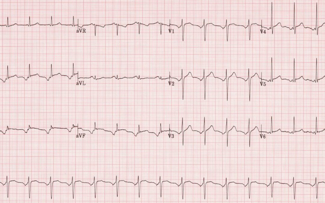 Dr Dave Richley ECG of the Month – January 2022