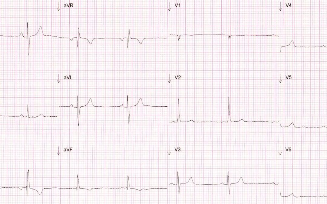 Dr Dave Richleys ECG of the Month – March 2022