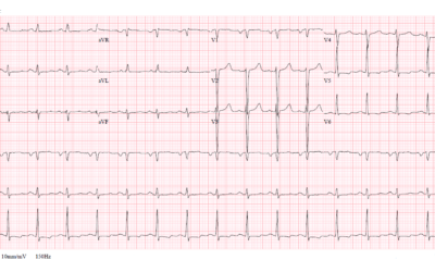 Dr Dave Richleys ECG of the Month – May 2022