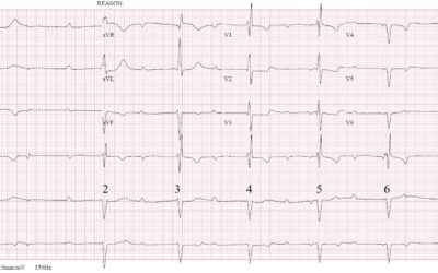 Dr Richleys ECG of the Month – February 2023