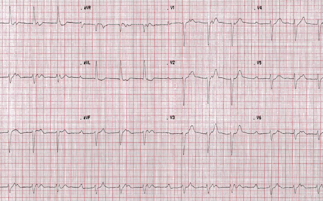 Dr Richleys ECG of the Month – January 2023