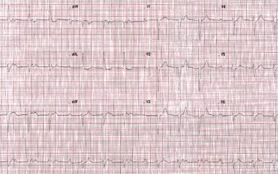 Dr Richleys ECG of the Month – January 2023